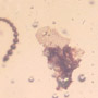 Rare Reptile Skin And Snail In Dominican Amber