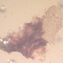 Rare Reptile Skin And Snail In Dominican Amber